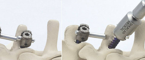Shukla Medical ผลิตงานต้นแบบเครื่องมือผ่าตัดด้วย Markforged Metal X